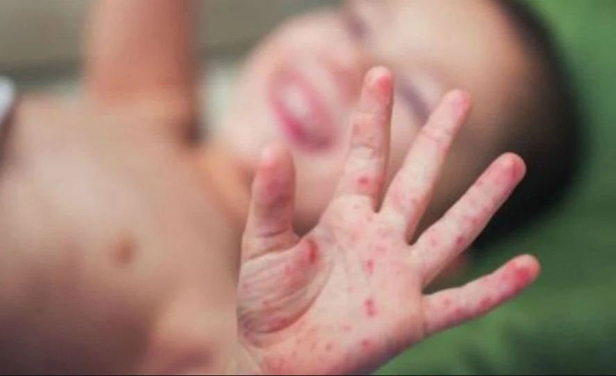 Measles seen in four in Gokarneshwar, Kathmandu