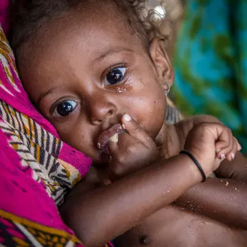 UN warns of soaring child malnutrition in Yemen