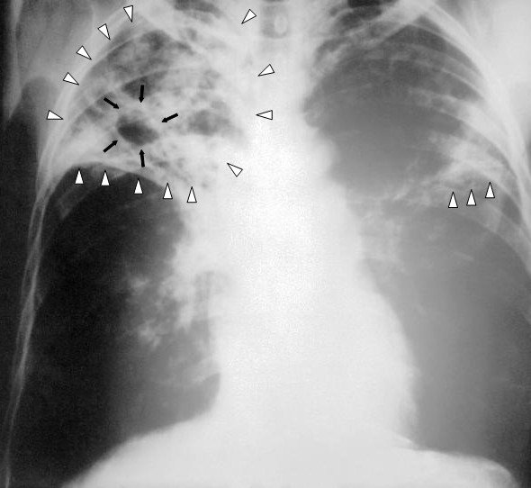 One hundred individuals diagnosed with tuberculosis in Okhaldhunga